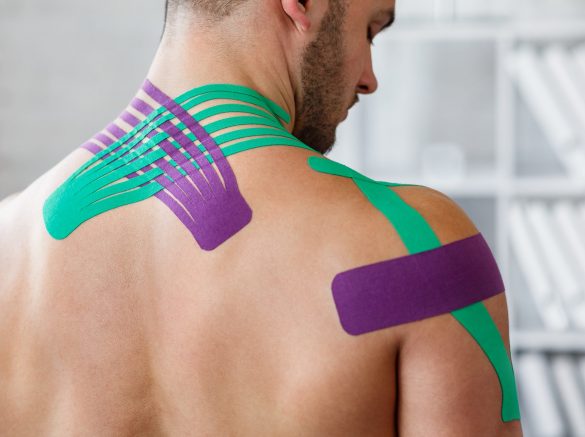 Kinesiology,Taping.,Kinesiology,Tape,On,Patient,Neck.,Injured,Trapezius,Muscles